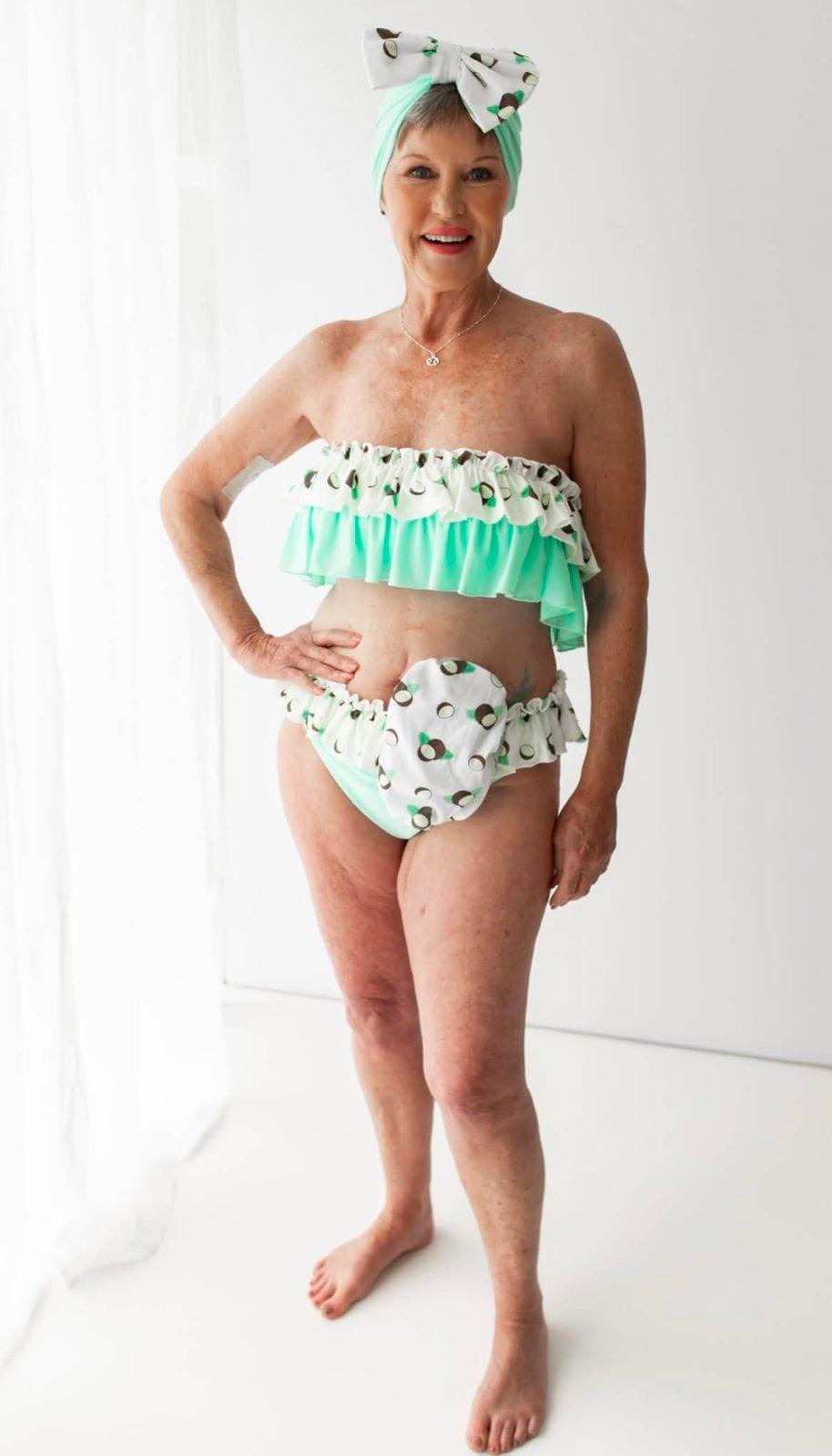 Toni, modelling Fruity & Frilly's coconut-print swimwear β the inspiration for the Adaptive Collection